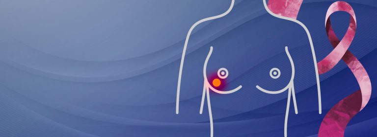 Intervenciones de Enfermería en la atención a pacientes con cáncer de mama